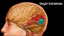 Küçük Beyin Kanaması Belirtileri ve Tedavisi