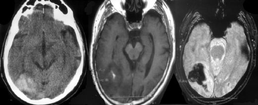 Beyin Kanaması Ateş Yapar mı?