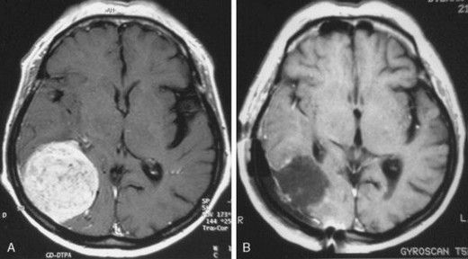 Beyin Tümörü Kanaması Belirtileri ve Tedavisi