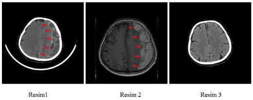 Travmaya Bağlı Beyin Kanaması Belirtileri ve Tedavisi